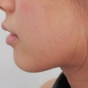 蚌埠韓美美萊整形醫(yī)院醫(yī)生張濤做玻尿酸墊下巴怎么樣？來看案例效果圖