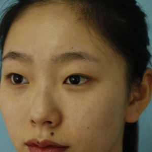 鄭州安格潤整形醫(yī)生楊曉紅做雙眼皮手術(shù)怎么樣？附案例效果圖