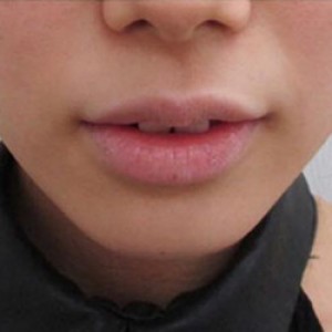 蚌埠韓美美萊整形醫(yī)院醫(yī)生張濤做玻尿酸墊下巴怎么樣？來看案例效果圖