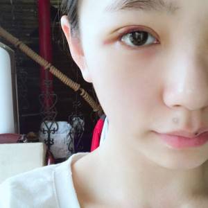 鄭州安格潤整形醫(yī)生楊曉紅做雙眼皮手術(shù)怎么樣？附案例效果圖