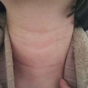 昭通愛麗諾整形醫(yī)生陳志江做嗨體去頸紋怎么樣？附案例效果圖