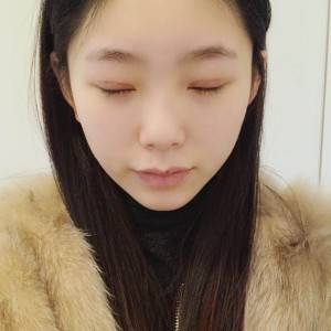 鄭州安格潤整形醫(yī)生楊曉紅做雙眼皮手術(shù)怎么樣？附案例效果圖