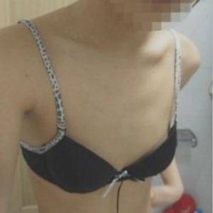 三亞圣迪亞整形美容醫(yī)院醫(yī)生韓超做假體隆胸怎么樣？附案例效果對(duì)比圖