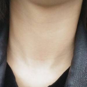 昭通愛麗諾整形醫(yī)生陳志江做嗨體去頸紋怎么樣？附案例效果圖