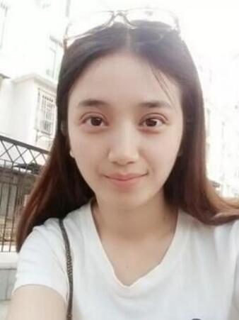 長治松禾醫(yī)療美容診所醫(yī)生馬俊峰做韓式微創(chuàng)定點雙眼皮效果怎么樣？附案例