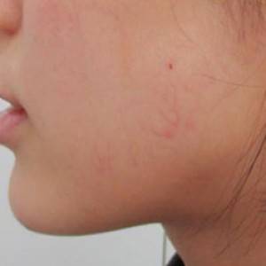 蚌埠韓美美萊整形醫(yī)院醫(yī)生張濤做玻尿酸墊下巴怎么樣？來看案例效果圖