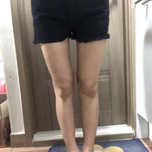 貴陽華美整形美容醫(yī)院醫(yī)生田永華做大腿吸脂效果怎么樣？附大腿吸脂案例前后對比圖