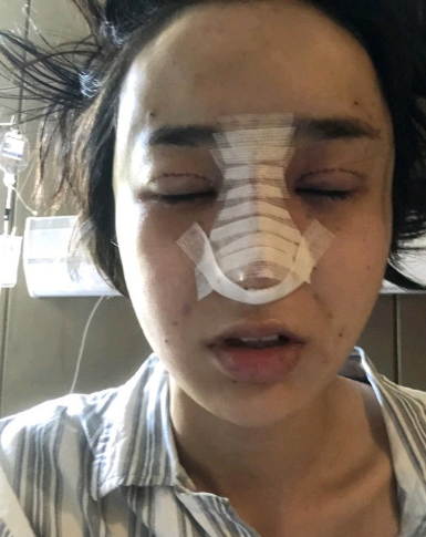 武漢米蘭醫(yī)療美容醫(yī)生柳再億做眼綜合+鼻綜合整形怎么樣？附真實(shí)案例對(duì)比圖