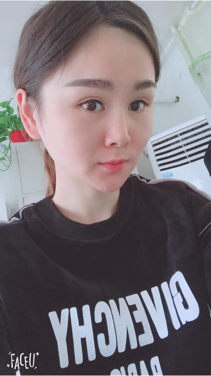 北京彤美美容整形醫(yī)院醫(yī)生楊曉惠做顴骨內(nèi)推+面部吸脂手術(shù)效果怎么樣？附案例