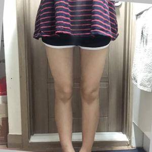 貴陽華美整形美容醫(yī)院醫(yī)生田永華做大腿吸脂效果怎么樣？附大腿吸脂案例前后對比圖