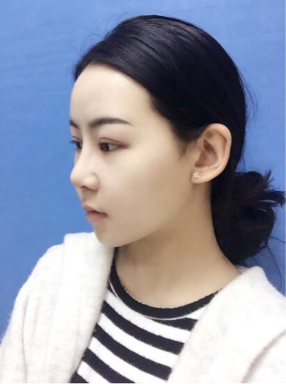 上海時(shí)光整形外科醫(yī)院醫(yī)生李靜林做假體隆鼻和反頜手術(shù)怎么樣？