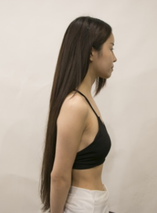 吉林現(xiàn)代整形美容醫(yī)院做假體隆胸效果怎么樣？附醫(yī)院案例效果對比圖