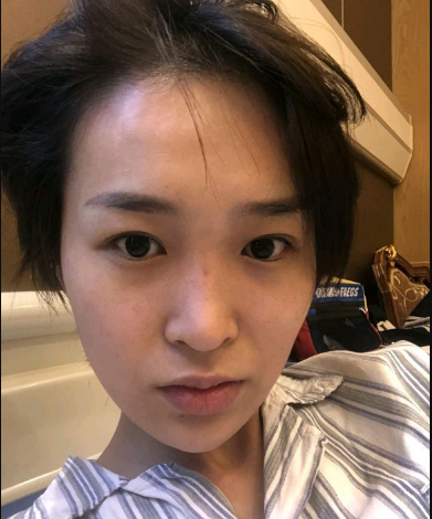 武漢米蘭醫(yī)療美容醫(yī)生柳再億做眼綜合+鼻綜合整形怎么樣？附真實(shí)案例對(duì)比圖