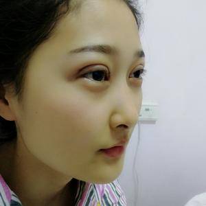 周口垣夢醫(yī)療整形醫(yī)生王濤做切開雙眼皮怎么樣？附切開雙眼皮案例效果對比圖