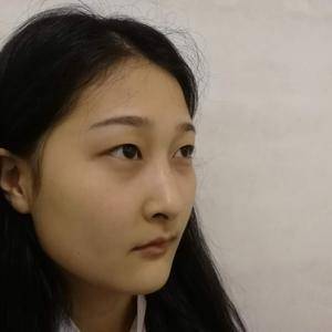 周口垣夢醫(yī)療整形醫(yī)生王濤做切開雙眼皮怎么樣？附切開雙眼皮案例效果對比圖