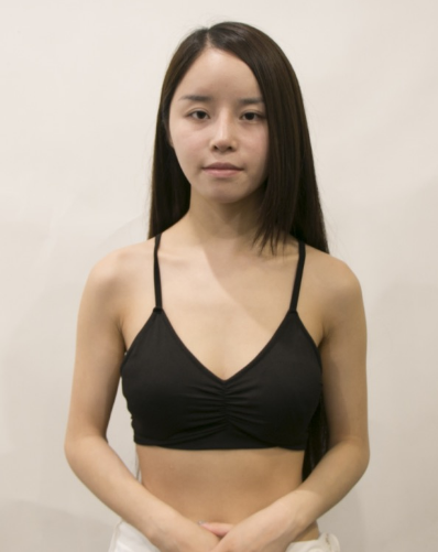 吉林現(xiàn)代整形美容醫(yī)院做假體隆胸效果怎么樣？附醫(yī)院案例效果對(duì)比圖