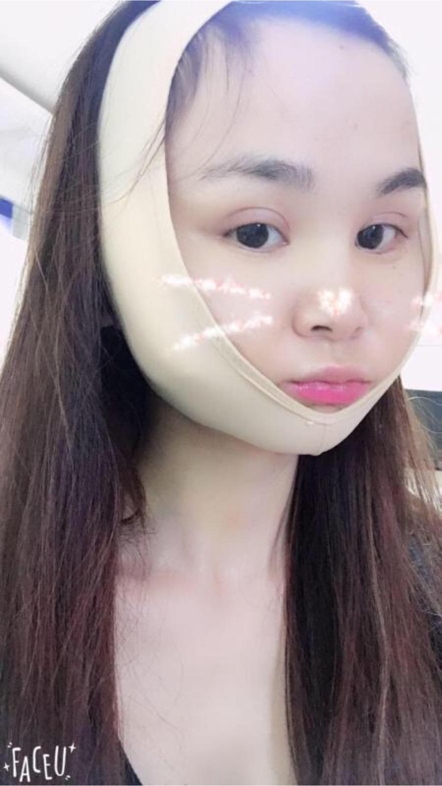 北京彤美美容整形醫(yī)院醫(yī)生楊曉惠做顴骨內(nèi)推+面部吸脂手術(shù)效果怎么樣？附案例