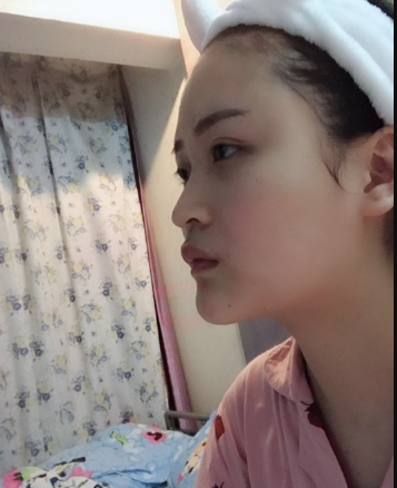 北京伊美爾美容愛康醫(yī)院醫(yī)生柳成做鼻綜合整形怎么樣？附案例效果圖