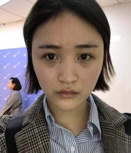 北京伊美爾美容愛康醫(yī)院醫(yī)生柳成做鼻綜合整形怎么樣？附案例效果圖