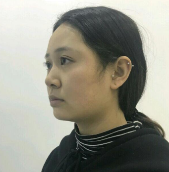 上海時光整形醫(yī)院做豐下巴怎么樣？許黎平醫(yī)生豐下巴案例分享