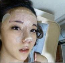 上海時(shí)光整形醫(yī)生何晉龍做假體隆鼻效果怎么樣？附案例效果對(duì)比圖