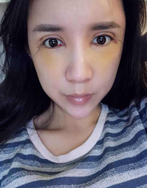 上海時光整形醫(yī)院張晶醫(yī)生做開眼角怎么樣？附真實效果圖