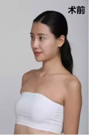 上海時光整形醫(yī)院何晉龍醫(yī)生做假體隆胸怎么樣？附案例對比圖
