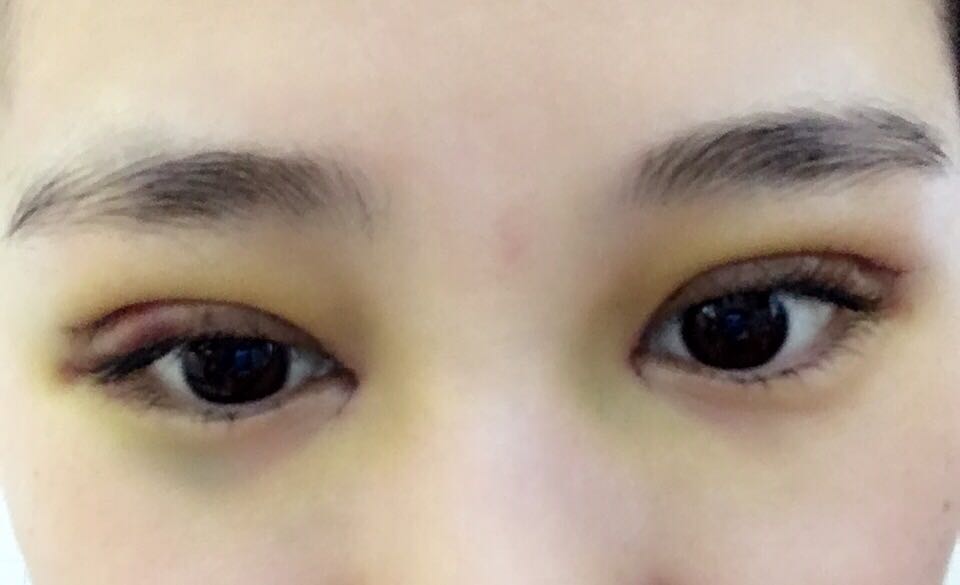 蚌埠韓美美萊整形醫(yī)生鄭捷做開眼角怎么樣？附案例效果圖