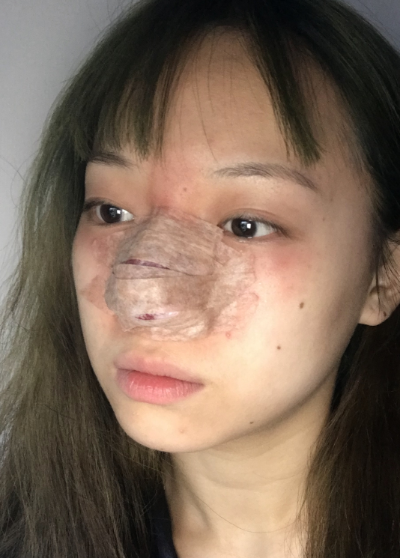 蚌埠韓美美萊整形做手術(shù)縮鼻頭效果怎么樣？附周娜醫(yī)生縮鼻頭案例效果圖