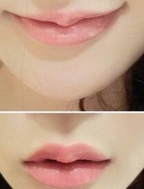 巴中時光醫(yī)學美容門診部做玻尿酸豐唇效果怎么樣？附李紅強豐唇案例