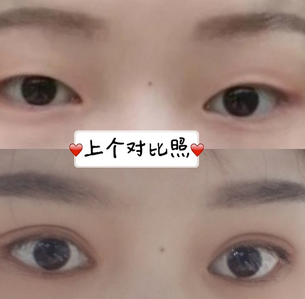 鞍山菲之都醫(yī)療整形醫(yī)院做開眼角+全切雙眼皮效果怎么樣？附藺嬌婷醫(yī)生案例