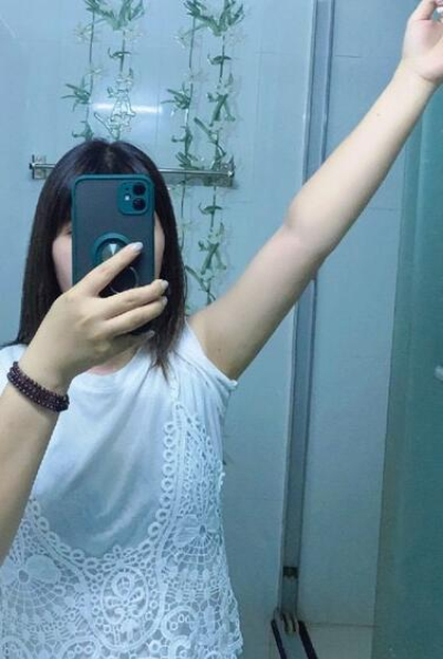蚌埠市第三人民醫(yī)院燒傷整形科楊蔚做手臂吸脂效果對(duì)比圖