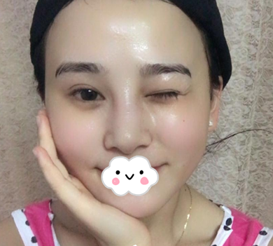 蚌埠韓美美萊整形醫(yī)生歷芳做耳軟骨隆鼻怎么樣？附耳軟骨隆鼻案例對比圖