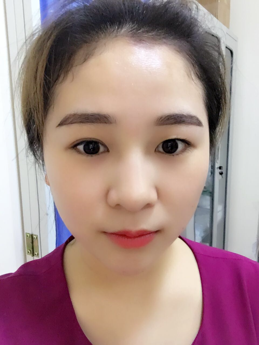 蚌埠韓美美萊整形醫(yī)生鄭捷做開眼角怎么樣？附案例效果圖
