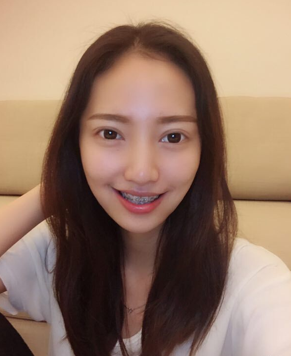 巴中華醫(yī)口腔醫(yī)院做牙齒矯正效果好嗎？附母汶靈醫(yī)生牙齒矯正案例效果圖