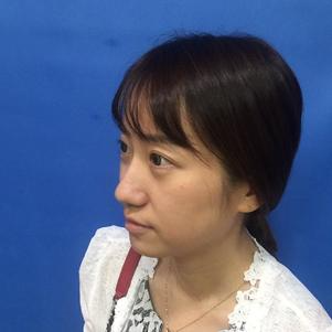 蚌埠韓美美萊整形做玻尿酸面部除皺效果怎么樣？附陳澤醫(yī)生案例效果圖