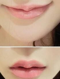 巴中時光醫(yī)學(xué)美容門診部做玻尿酸豐唇效果怎么樣？附李紅強豐唇案例