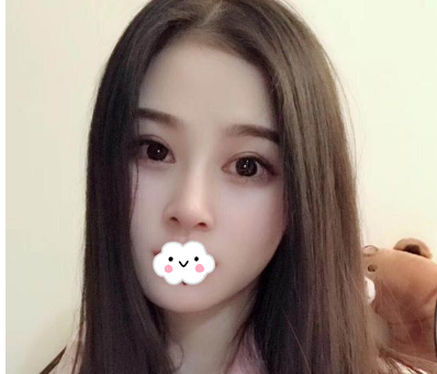 蚌埠韓美美萊整形醫(yī)生歷芳做耳軟骨隆鼻怎么樣？附耳軟骨隆鼻案例對比圖