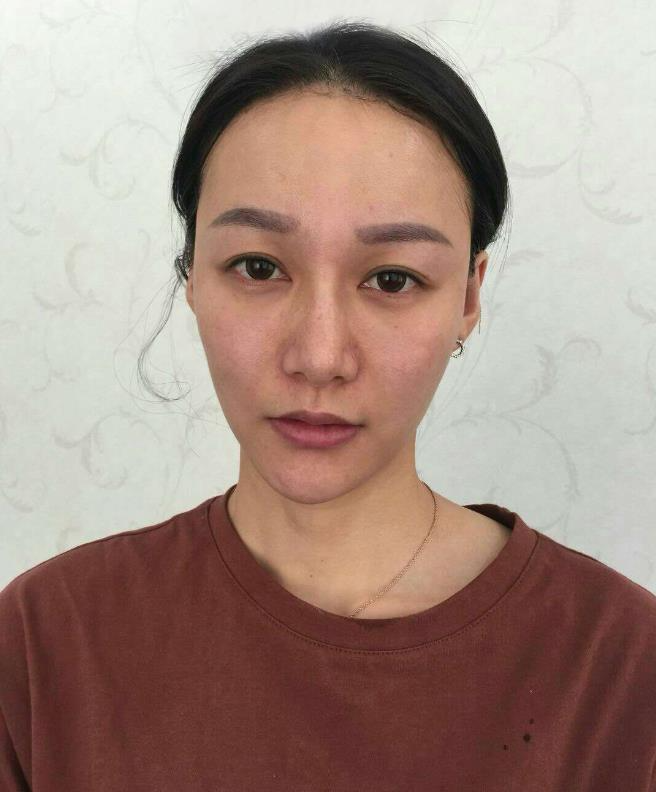 鞍山王景醫(yī)療美容外科診所做光子嫩膚怎么樣？附王景醫(yī)生案例效果圖
