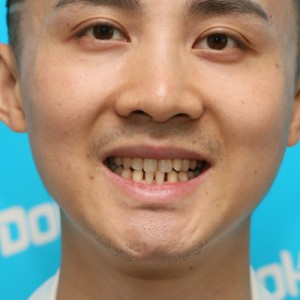 鞍山時(shí)代口腔門診部做瓷貼面怎么樣？附孫興國(guó)醫(yī)生瓷貼面案例效果圖