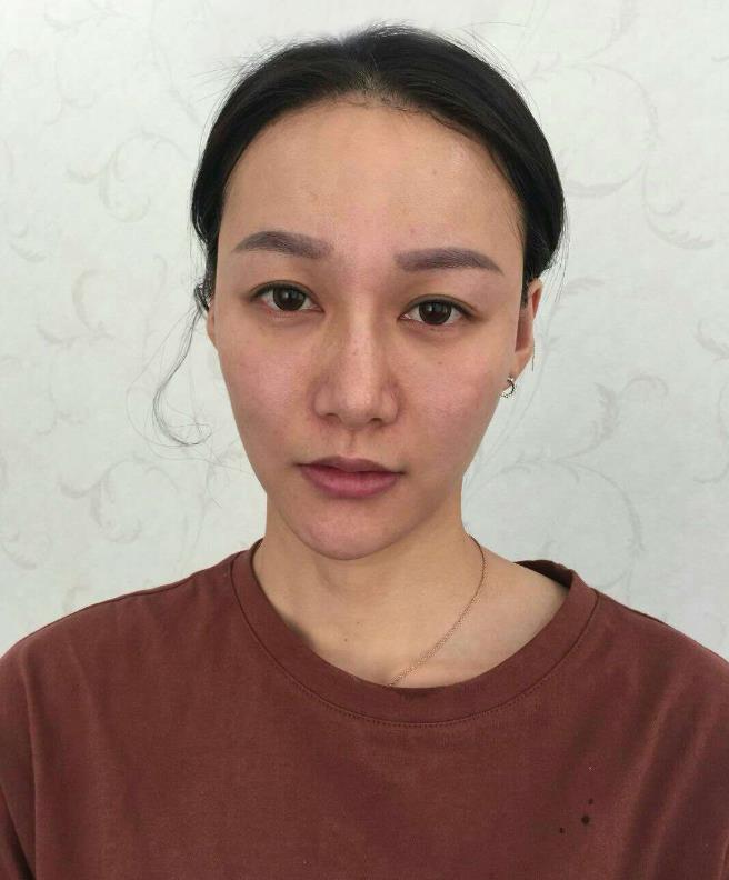 鞍山王景醫(yī)療美容外科診所做光子嫩膚怎么樣？附王景醫(yī)生案例效果圖