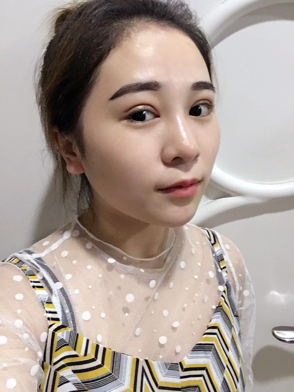 蚌埠韓美美萊整形醫(yī)生鄭捷做開眼角怎么樣？附案例效果圖