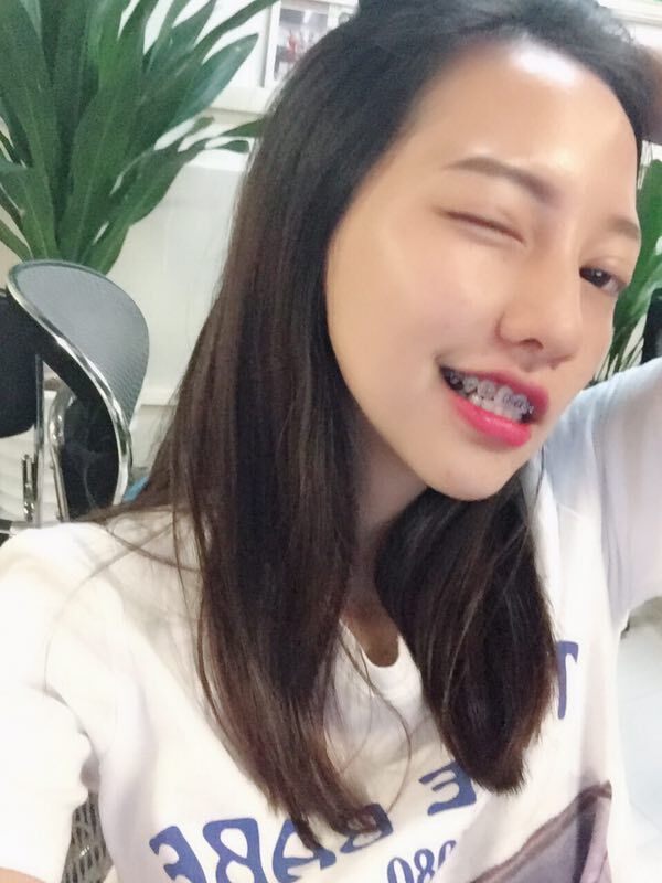 巴中華醫(yī)口腔醫(yī)院做牙齒矯正效果好嗎？附母汶靈醫(yī)生牙齒矯正案例效果圖