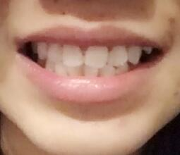 鞍山時代口腔門診部劉昕醫(yī)生做美容冠效果怎么樣？一起來看看吧