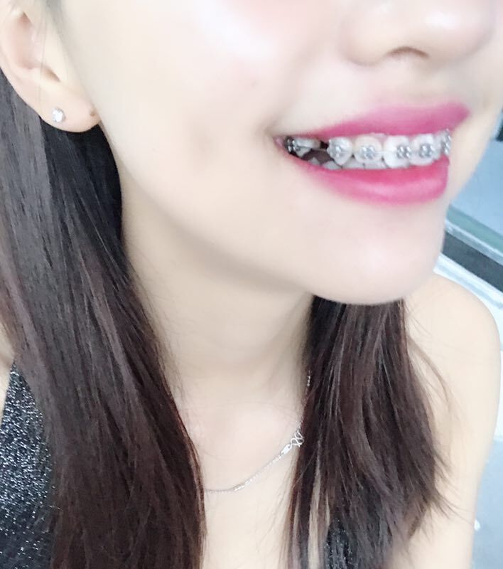 巴中華醫(yī)口腔醫(yī)院做牙齒矯正效果好嗎？附母汶靈醫(yī)生牙齒矯正案例效果圖