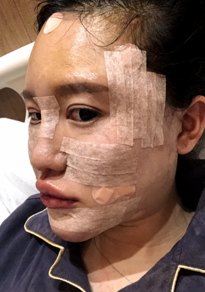蚌埠韓美美萊整形醫(yī)生張燕做自體脂肪豐面頰效果怎么樣？附案例效果圖