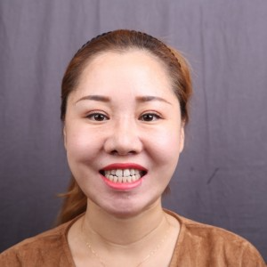 保定東陽(yáng)口腔醫(yī)院趙晨醫(yī)生做瓷貼面怎么樣？附瓷貼面案例效果對(duì)比圖