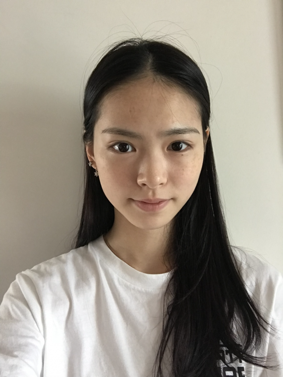 保定市第五醫(yī)院美容整形科做激光祛斑怎么樣？附單敬依醫(yī)生案例效果圖