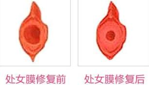 蚌埠市第三人民醫(yī)院燒傷整形科許瑾醫(yī)生做處女摸修復怎么樣？附案例