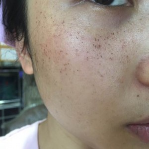 寶雞皮膚病醫(yī)院文東亮醫(yī)生做臉部祛斑效果怎么樣？附臉部祛斑案例